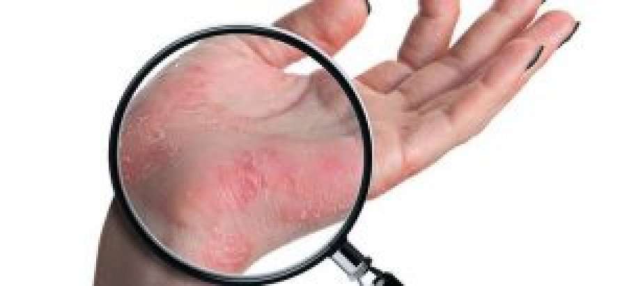 Kanceri i lëkurës, rritet numri i rasteve në botë