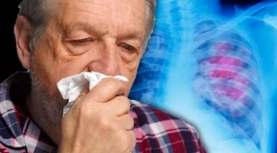 Ngjyra e këlbazës mund të tregojë nëse keni kancer të mushkërive