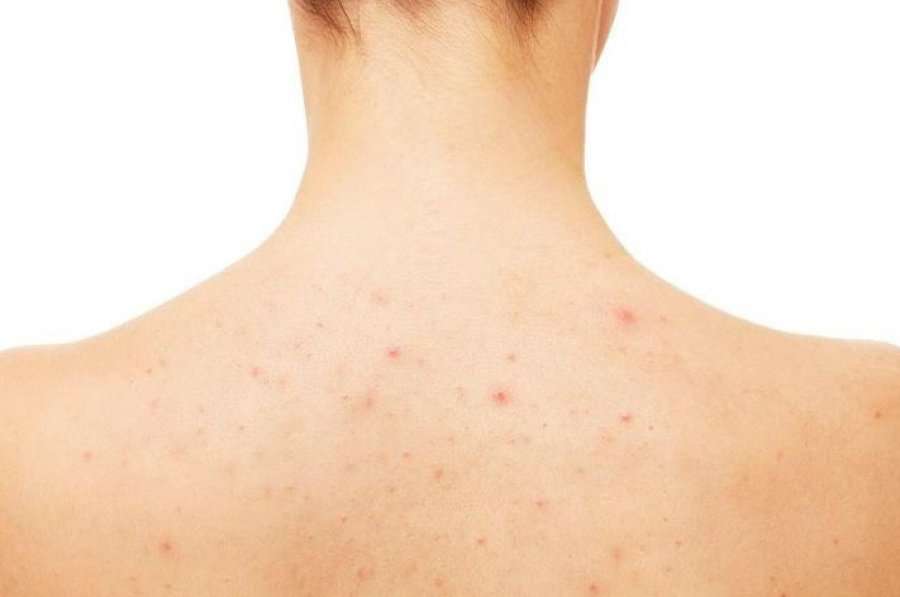 Cili është shkaku i puçrrave të vogla në trup? 