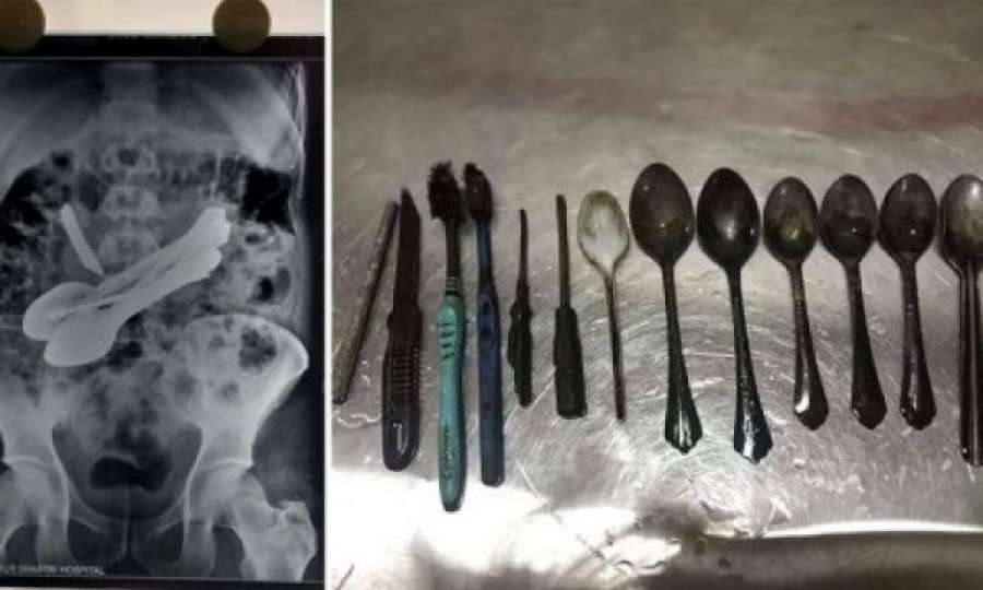 Mjekët heqin tetë lugë dhe një thikë nga zorrët e pacientit