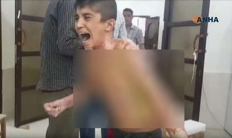Pamje tmerruese të fëmijëve kurdë; Turqia dyshohet se po përdor armë kimike