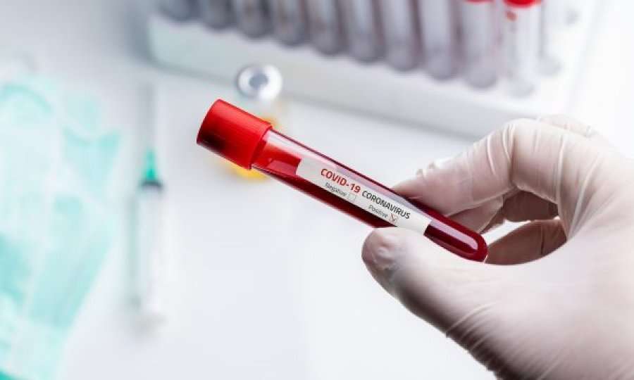 Tri viktima dhe 141 raste të reja me koronavirus në Shqipëri