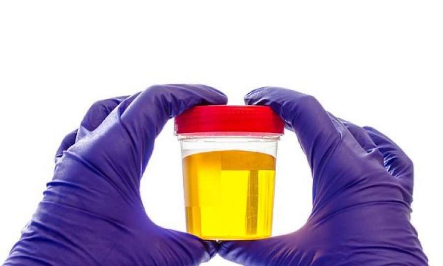 Testi i thjeshtë i urinës që mund ta zbulojë 10 vjet më herët kancerin e fshikëzës së urinës