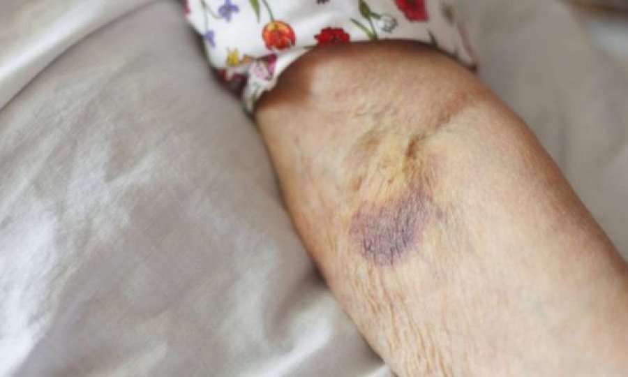 Këto simptoma nuk bën t’i injoroni: Janë shenjat më të hershme që në trup po formohet trombi i cili mund të jetë vdekjeprurës!