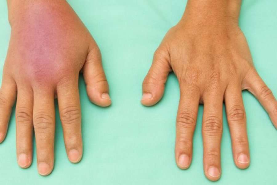 Çfarë është inflamacioni dhe përse është i rrezikshëm