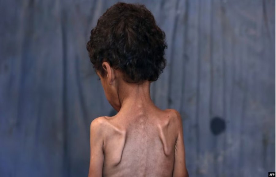 Save the Children: Fëmijët e uritur në Gazë nuk kanë forcë as të qajnë