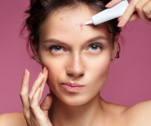 Këto janë pesë arsyet e thjeshta pse nuk po ju zhduken puçrrat nga fytyra