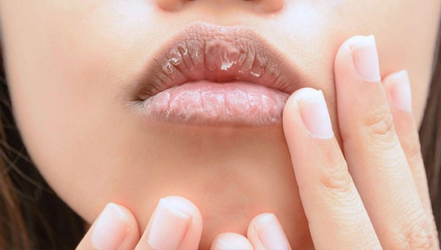 kater-arsyet-pse-i-keni-buzet-e-plasaritura-gjate-dimrit