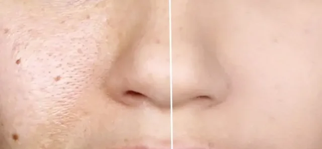 Maskë perfekte për eliminimin e poreve, në kushte shtëpie