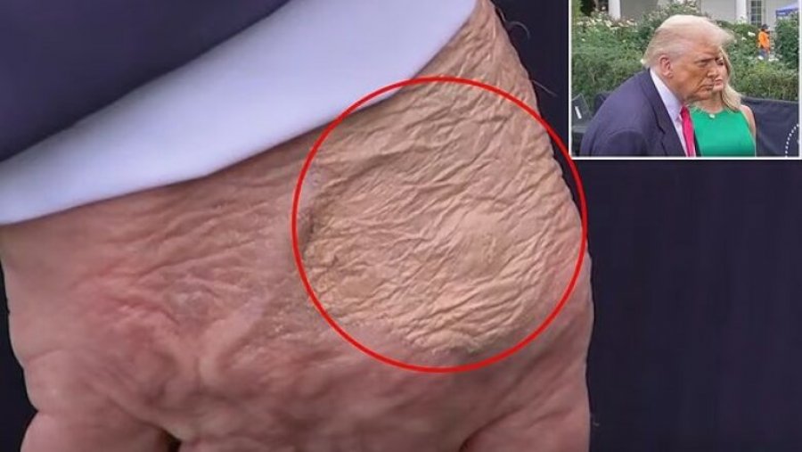 Disa shenja shfaqen në dorën e Trumpit, ekspertët zbulojnë se çfarë janë ato në të vërtetë