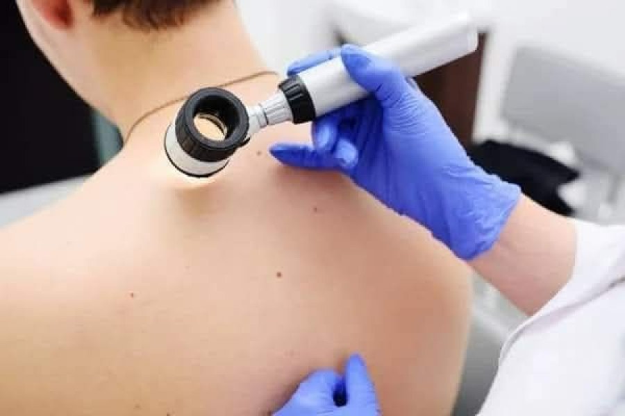 Dermatoskopi falas në Spitalin e Pejës në kuadër të fushatës për vetëdijesim ndaj kancerit të lëkurës