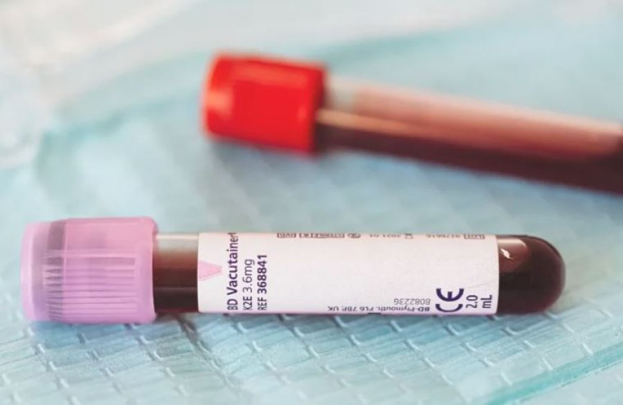 Etiopia konfirmon 3 viktima nga virusi vdekjeprurës Marburg, shpallet shpërthim i ri