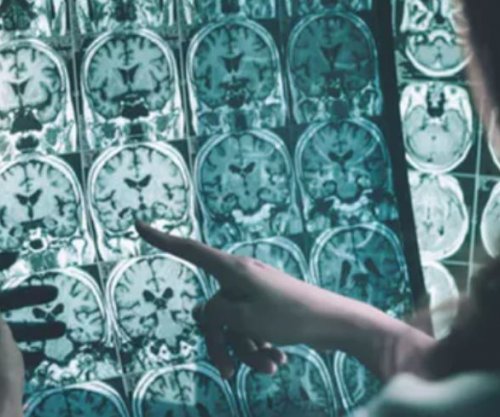 Vdekshmëria nga goditja në tru në Zvicër është përgjysmuar në 20 vitet e fundit