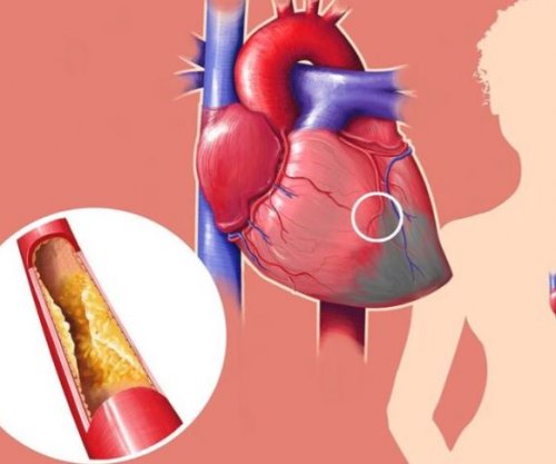 Pilulat e reja për uljen e kolesterolit mund të revolucionarizojnë trajtimin e sëmundjeve të zemrës