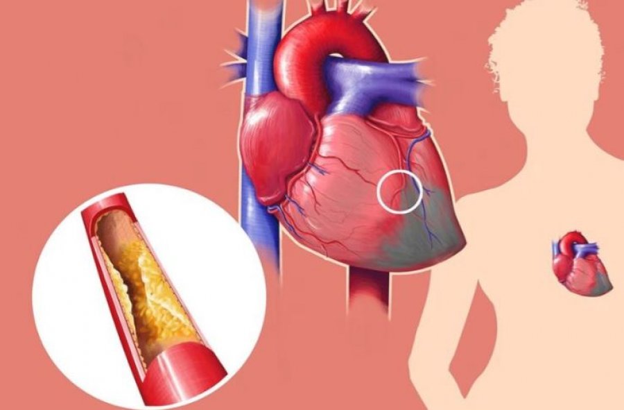 Pilulat e reja për uljen e kolesterolit mund të revolucionarizojnë trajtimin e sëmundjeve të zemrës