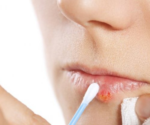 Mënyra natyrale për të shëruar herpesin e buzës
