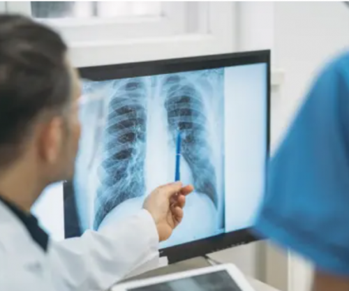 Inteligjenca artificiale ndihmon në zbulimin e hershëm të kancerit të mushkërive