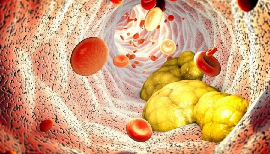 Kolesteroli i lartë shoqërohet me jetëgjatësi më të madhe