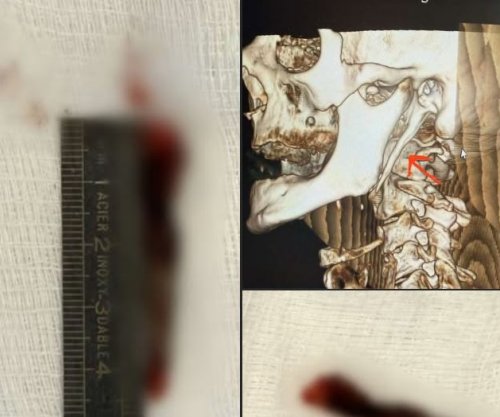 Për herë të parë në Kosovë kryhet me sukses operacioni për sindromën “Eagle”