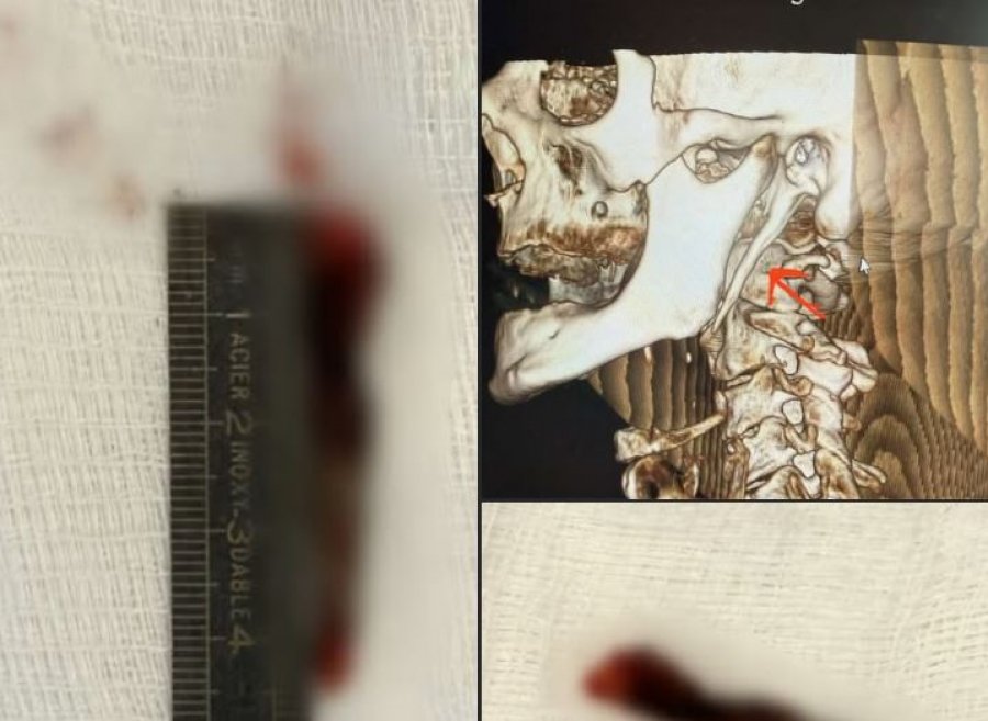 Për herë të parë në Kosovë kryhet me sukses operacioni për sindromën “Eagle”