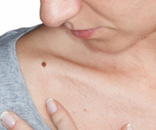 Bëni kujdes, nishanet në trupin tuaj mund t’ju sinjalizojnë një rrezik të madh për shëndetin