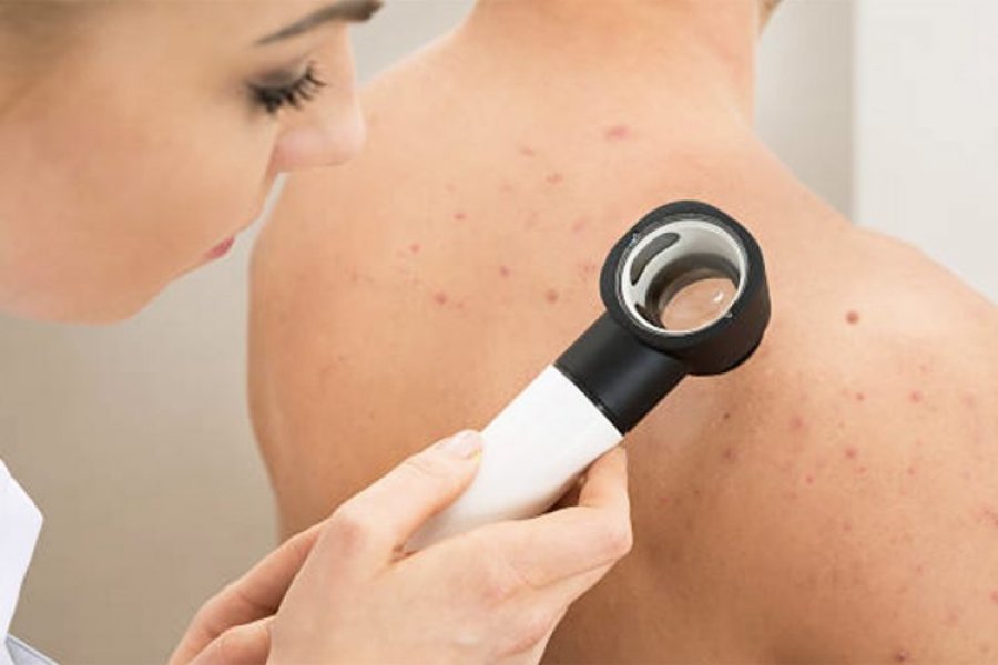 pese-shenjat-e-crregullimeve-hormonale