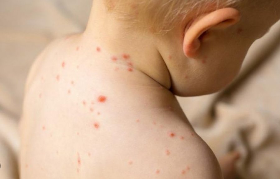 Tre fëmijë të infektuar me fruth në Tiranë