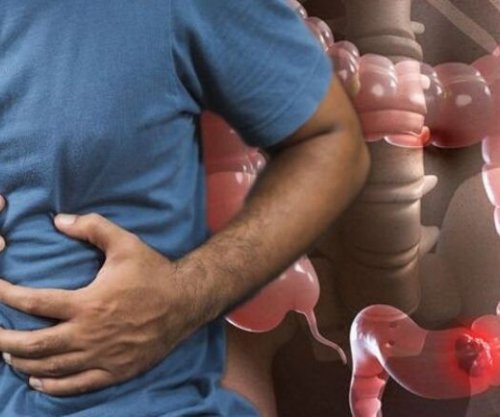 Gastroenterologu kosovar: Kanceri i zorrës së trashë mund të zhvillohet pa asnjë simptomë