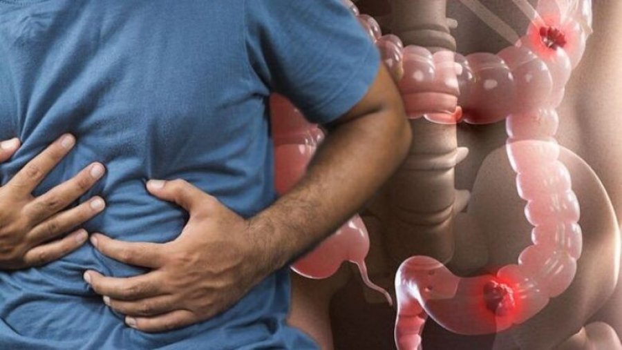 Gastroenterologu kosovar  Kanceri i zorrës së trashë mund të zhvillohet pa asnjë simptomë