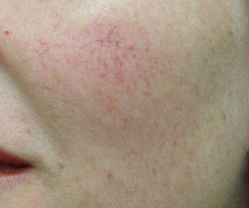 Kapilarët e kuq në fytyrë, si t’i trajtoni?