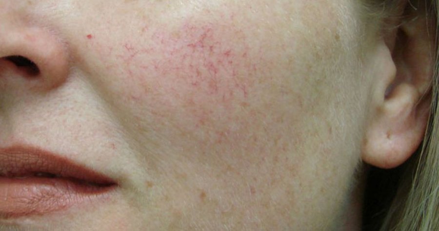 Kapilarët e kuq në fytyrë, si t’i trajtoni?