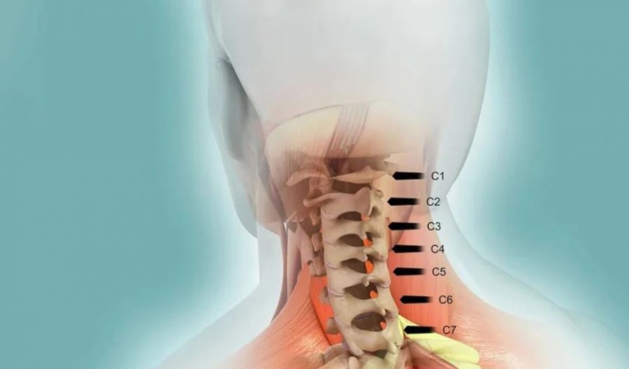 Lëndimet më të rënda të palcës kurrizore  Kur dëmtohen dy rruazat e qafës  pasojat mund të jenë fatale