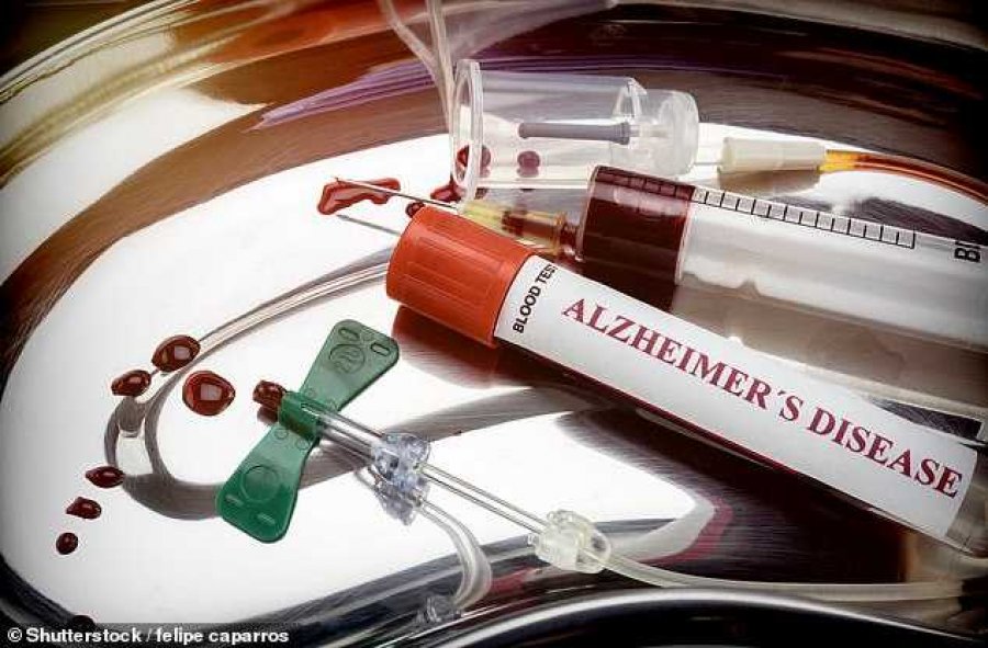 Shkencëtarët zbulojnë se si zhvillohet sëmundja Alzheimer në tru