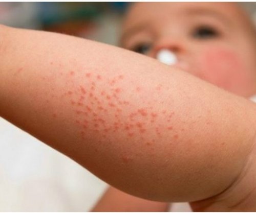 Mjekët paralajmërojnë për rritjen e alergjive ushqimore te fëmijët