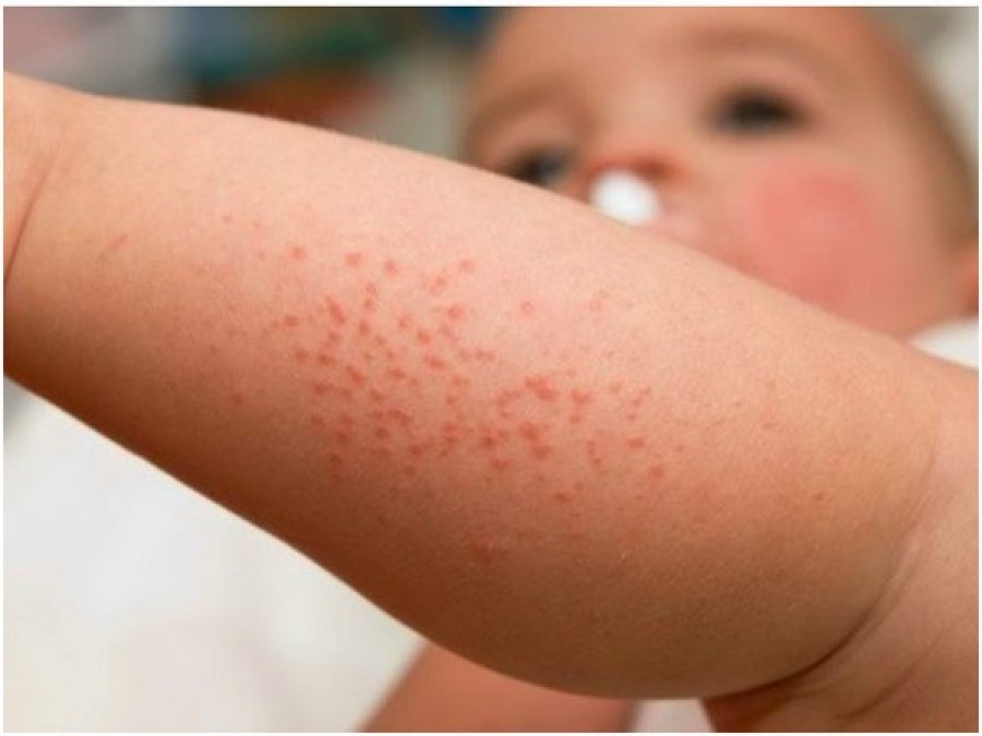 mjeket-paralajmerojne-per-rritjen-e-alergjive-ushqimore-te-femijet