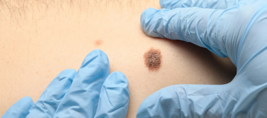dermatologet-ne-maqedoni-zbulojne-raste-te-dyshimta-te-kancerit-te-lekures-gjate-kontrolleve-falas