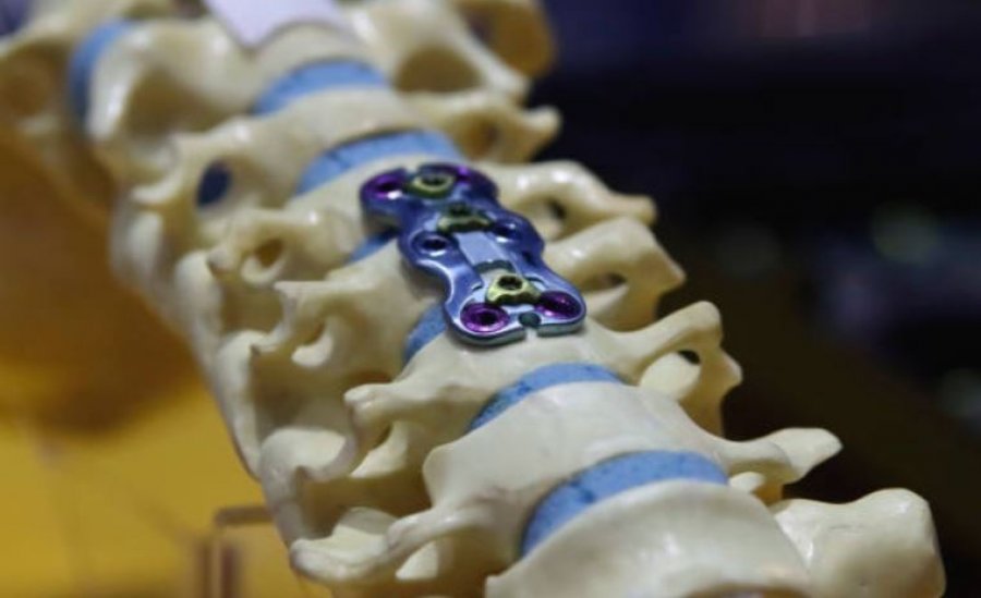 Shkencëtarët zbulojnë se implantet dentare mund të ndikojnë në reagimin imunitar ndaj infeksioneve