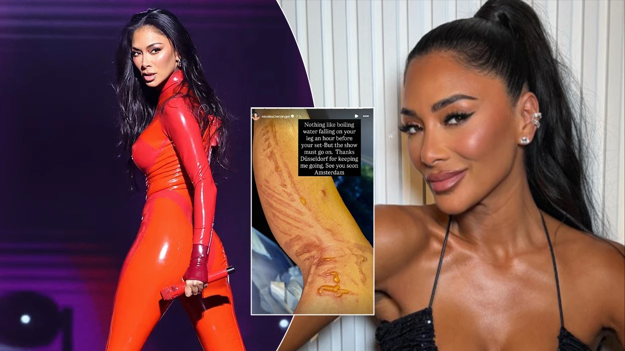 Nicole Scherzinger pëson djegie pak para koncertit, por nuk anulon performancë